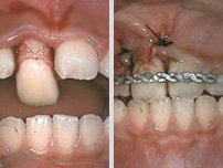 （左：外傷による脱臼歯、右：ワイヤによる脱臼歯の固定）